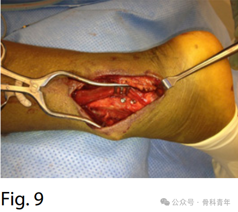 手术“金标准”：后外侧入路固定后踝骨折的手术步骤详解（JBJS经验）