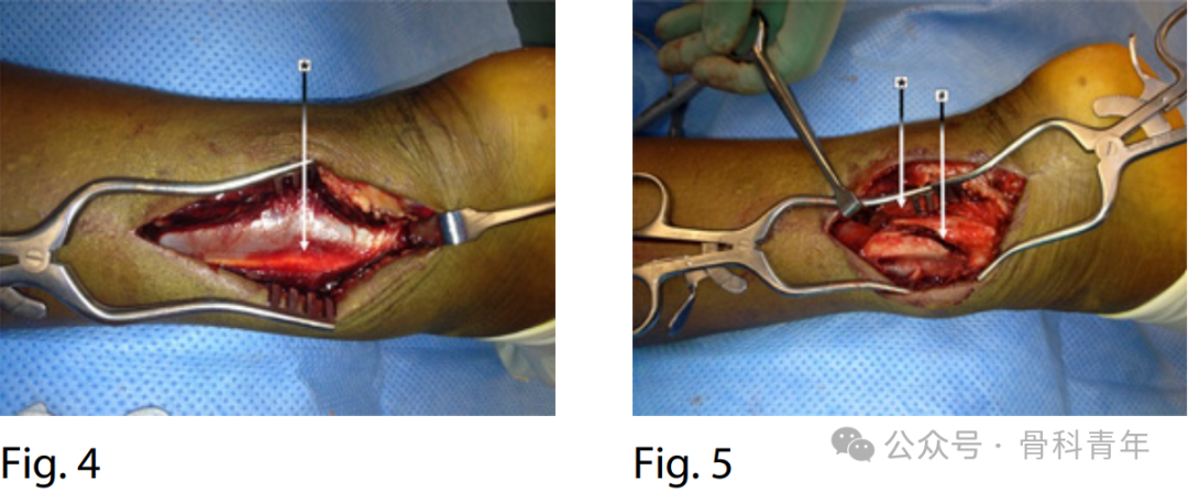 手术“金标准”：后外侧入路固定后踝骨折的手术步骤详解（JBJS经验）