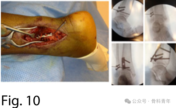 手术“金标准”：后外侧入路固定后踝骨折的手术步骤详解（JBJS经验）