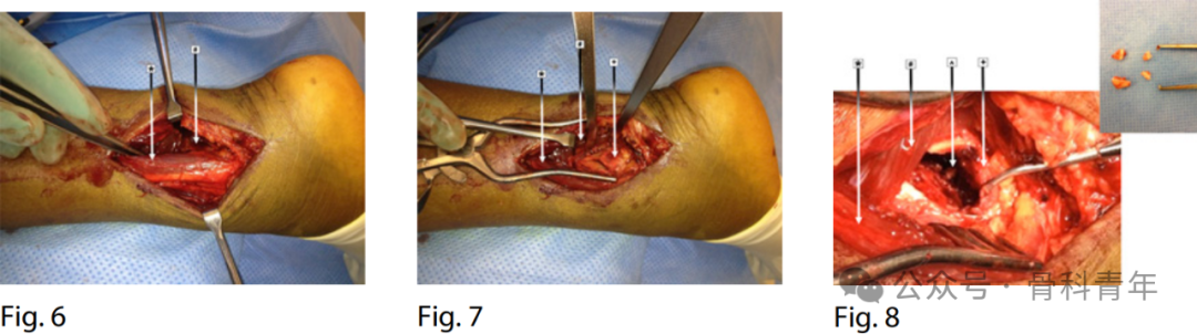 手术“金标准”：后外侧入路固定后踝骨折的手术步骤详解（JBJS经验）