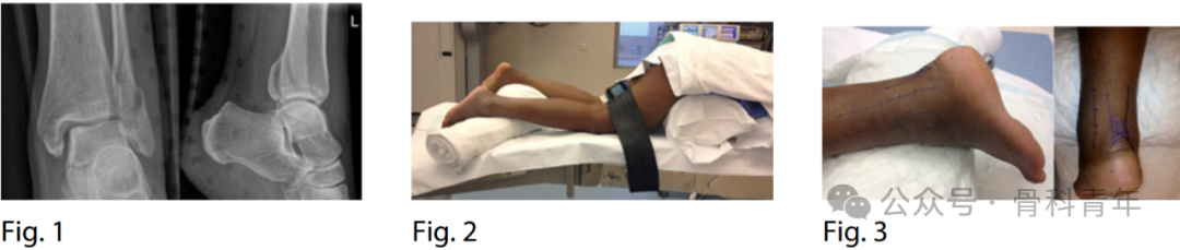 手术“金标准”：后外侧入路固定后踝骨折的手术步骤详解（JBJS经验）