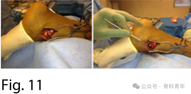 手术“金标准”：后外侧入路固定后踝骨折的手术步骤详解（JBJS经验）