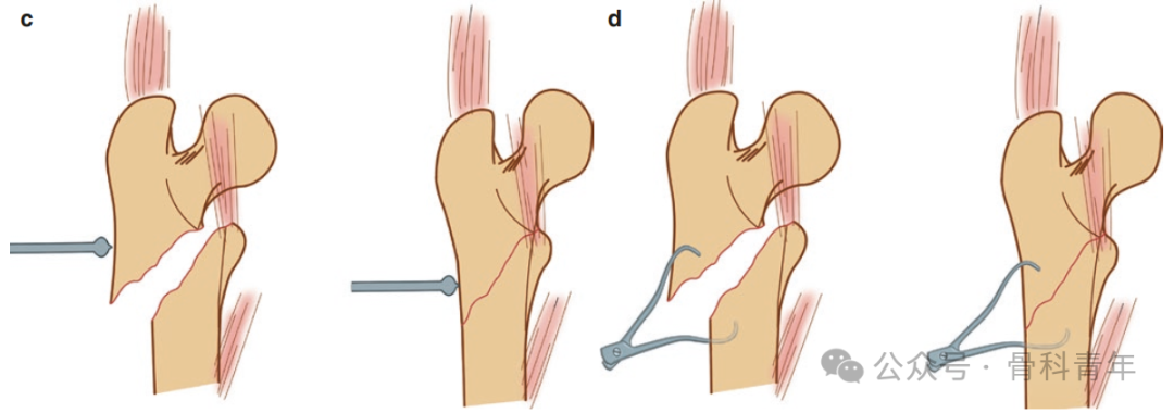 手术技巧｜“血管钳撬拨技术”辅助复位粗隆下骨折