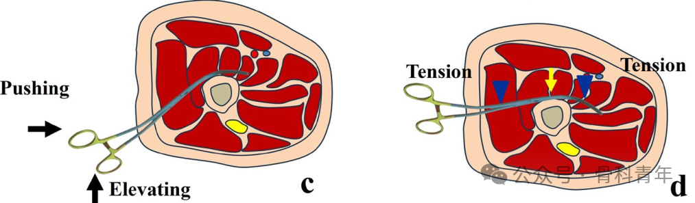 手术技巧｜“血管钳撬拨技术”辅助复位粗隆下骨折