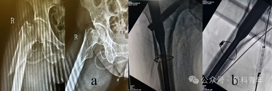 手术技巧｜“血管钳撬拨技术”辅助复位粗隆下骨折