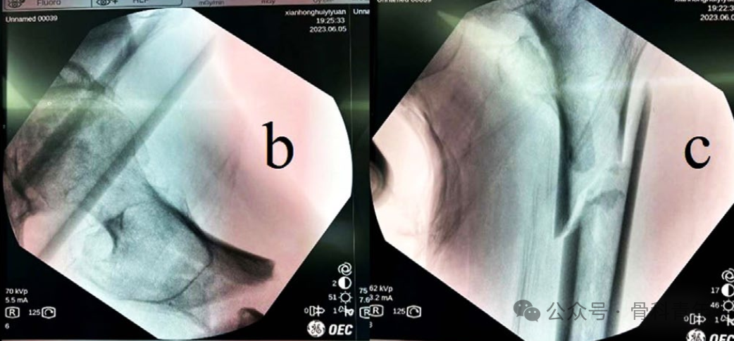 手术技巧｜“血管钳撬拨技术”辅助复位粗隆下骨折