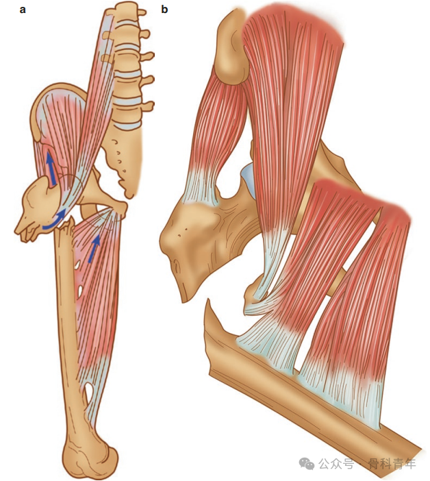 手术技巧｜“血管钳撬拨技术”辅助复位粗隆下骨折