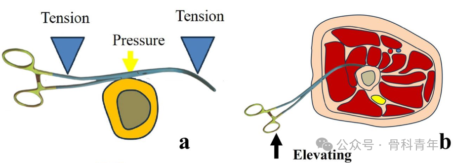 手术技巧｜“血管钳撬拨技术”辅助复位粗隆下骨折