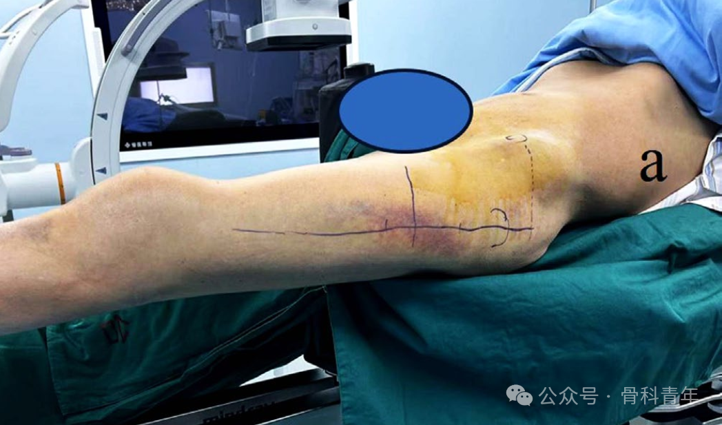 手术技巧｜“血管钳撬拨技术”辅助复位粗隆下骨折