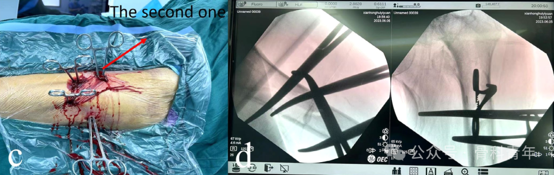 手术技巧｜“血管钳撬拨技术”辅助复位粗隆下骨折