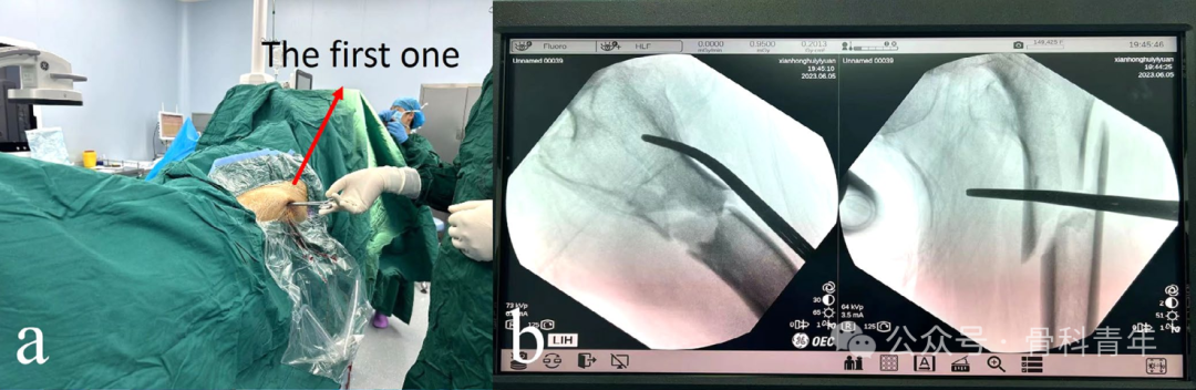 手术技巧｜“血管钳撬拨技术”辅助复位粗隆下骨折
