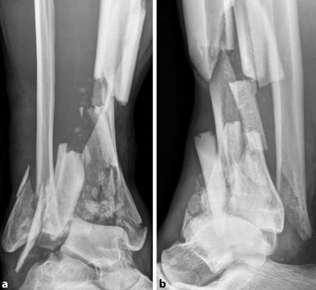 复杂Pilon骨折：“四原则”与“四步定基法”