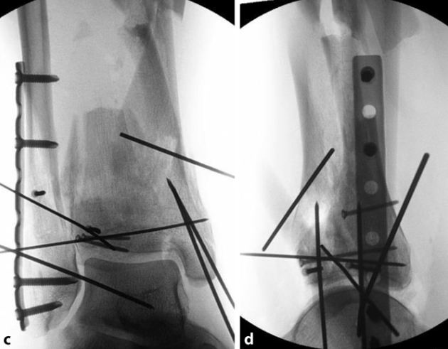 复杂Pilon骨折：“四原则”与“四步定基法”