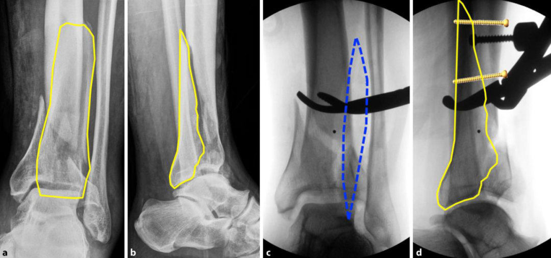 复杂Pilon骨折：“四原则”与“四步定基法”