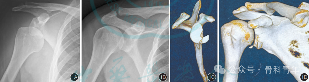 “腋窝入路”显露肩胛盂：解剖与手术技术