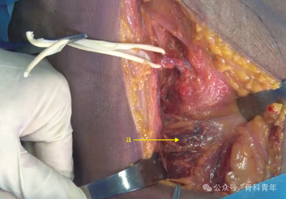 “腋窝入路”显露肩胛盂：解剖与手术技术
