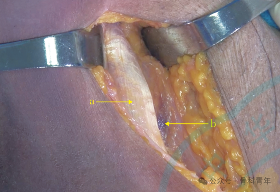 “腋窝入路”显露肩胛盂：解剖与手术技术