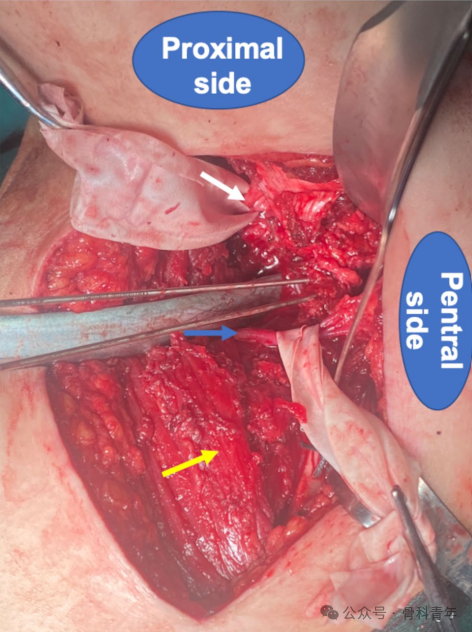 “腋窝入路”显露肩胛盂：解剖与手术技术