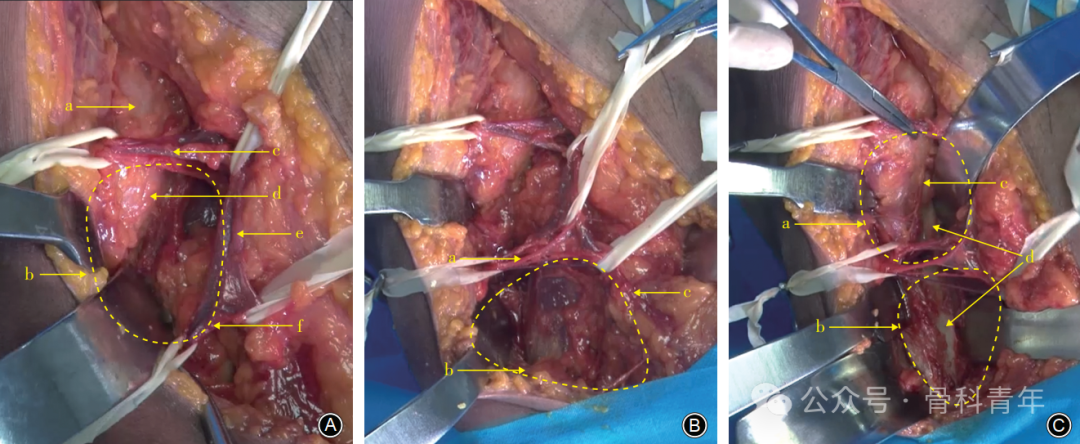 “腋窝入路”显露肩胛盂：解剖与手术技术