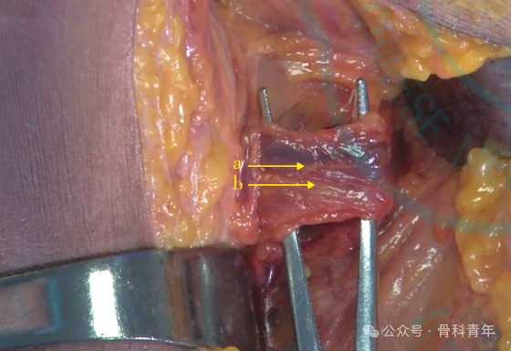 “腋窝入路”显露肩胛盂：解剖与手术技术
