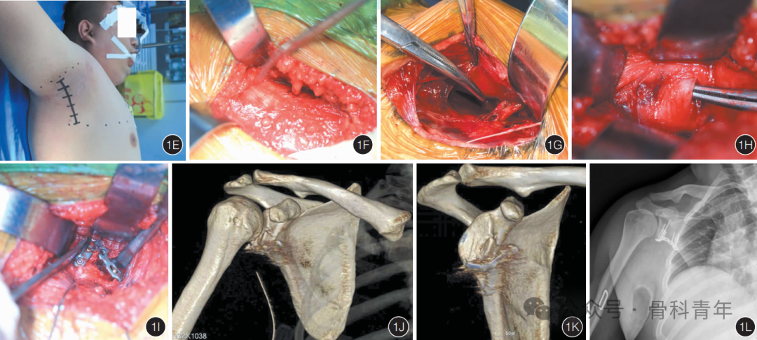 “腋窝入路”显露肩胛盂：解剖与手术技术