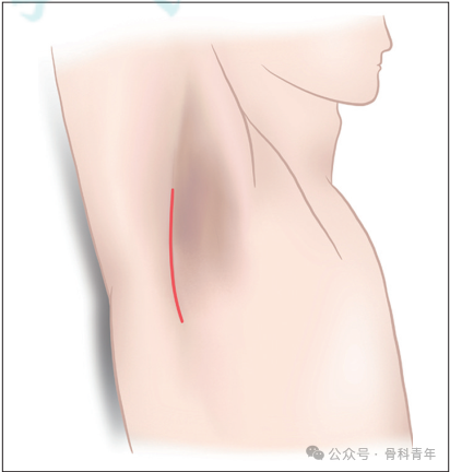 “腋窝入路”显露肩胛盂：解剖与手术技术