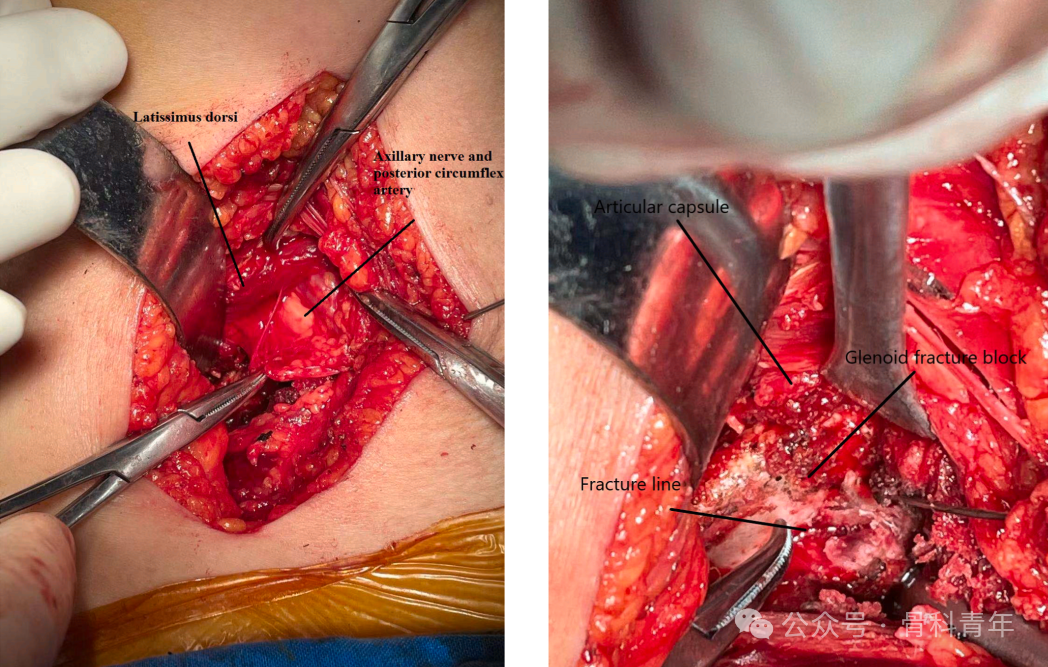 “腋窝入路”显露肩胛盂：解剖与手术技术