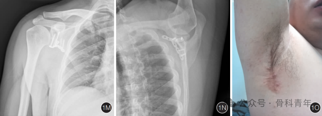 “腋窝入路”显露肩胛盂：解剖与手术技术