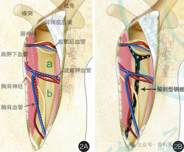 “腋窝入路”显露肩胛盂：解剖与手术技术