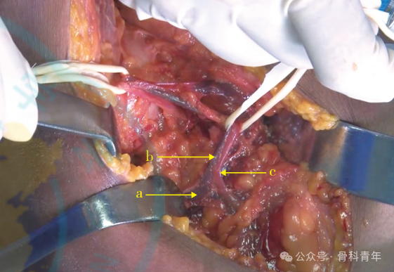 “腋窝入路”显露肩胛盂：解剖与手术技术