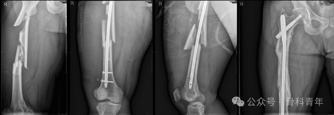 长管骨粉碎性骨折髓内固定，钢丝环扎有益吗？