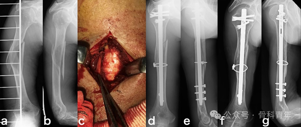 长管骨粉碎性骨折髓内固定，钢丝环扎有益吗？