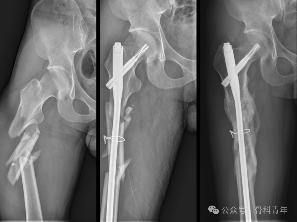 长管骨粉碎性骨折髓内固定，钢丝环扎有益吗？