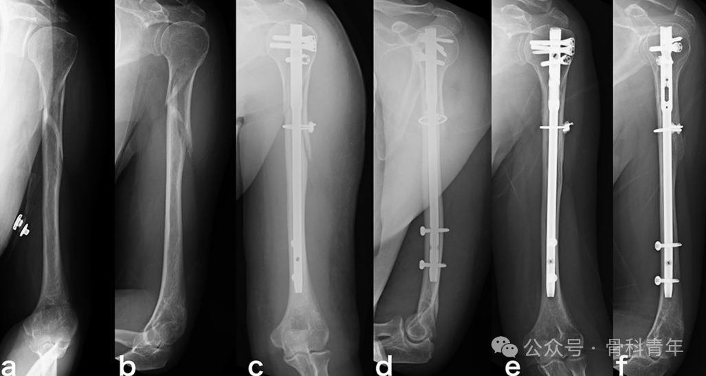 长管骨粉碎性骨折髓内固定，钢丝环扎有益吗？