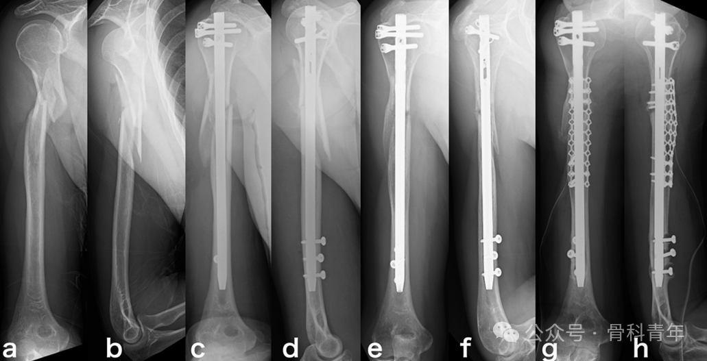 长管骨粉碎性骨折髓内固定，钢丝环扎有益吗？