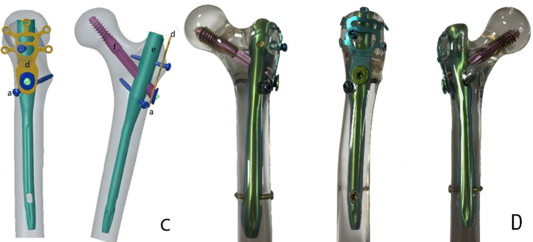 新型PFUN，会是粗隆间骨折内固定的更优解吗？