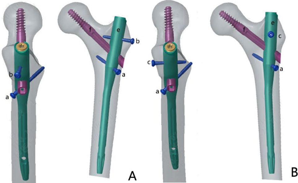 新型PFUN，会是粗隆间骨折内固定的更优解吗？