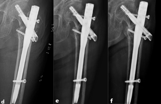 新型PFUN，会是粗隆间骨折内固定的更优解吗？