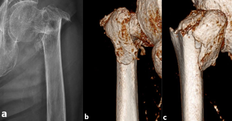 新型PFUN，会是粗隆间骨折内固定的更优解吗？