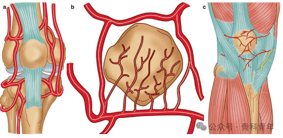手术“金标准”：“克氏针张力带”内固定治疗髌骨骨折