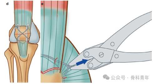 手术“金标准”：“克氏针张力带”内固定治疗髌骨骨折
