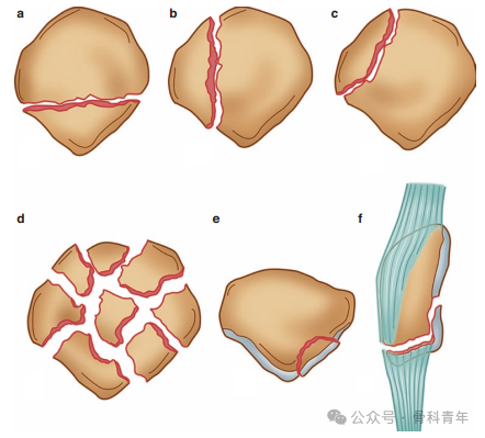 手术“金标准”：“克氏针张力带”内固定治疗髌骨骨折