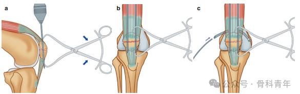 手术“金标准”：“克氏针张力带”内固定治疗髌骨骨折