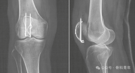 手术“金标准”：“克氏针张力带”内固定治疗髌骨骨折