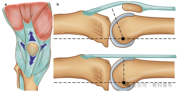 手术“金标准”：“克氏针张力带”内固定治疗髌骨骨折