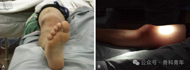 手术“金标准”：“克氏针张力带”内固定治疗髌骨骨折