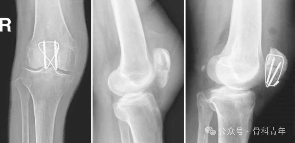 手术“金标准”：“克氏针张力带”内固定治疗髌骨骨折