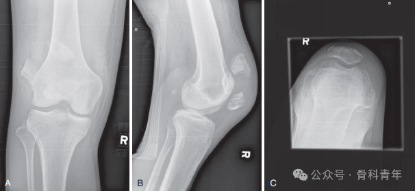 手术“金标准”：“克氏针张力带”内固定治疗髌骨骨折