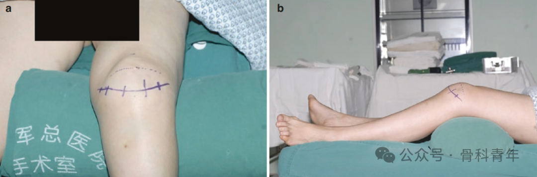 手术“金标准”：“克氏针张力带”内固定治疗髌骨骨折