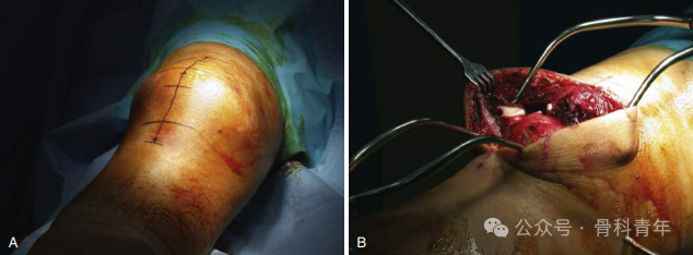 手术“金标准”：“克氏针张力带”内固定治疗髌骨骨折